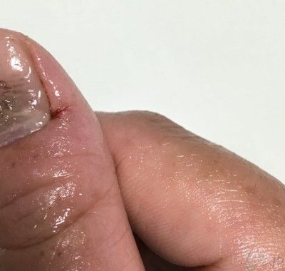 割れる 指先 手の指先のひび割れの原因と対策は？治し方は、やけどの治療と同じ方法！