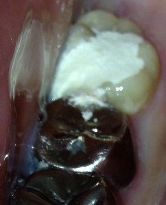 虫歯になった親知らずの抜髄から始まる虫歯治療