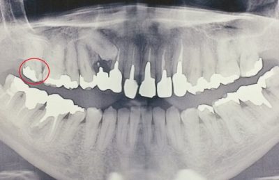 歯科で奥歯の神経を取ったけど新人歯科医で大変だった
