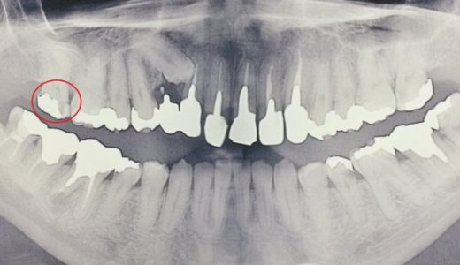 歯科で奥歯の神経を取ったけど新人歯科医で大変だった