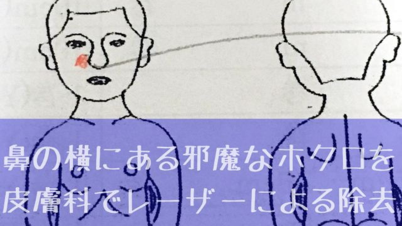 所要時間３０分 鼻の横にある邪魔なホクロをレーザーで除去 あつラボ